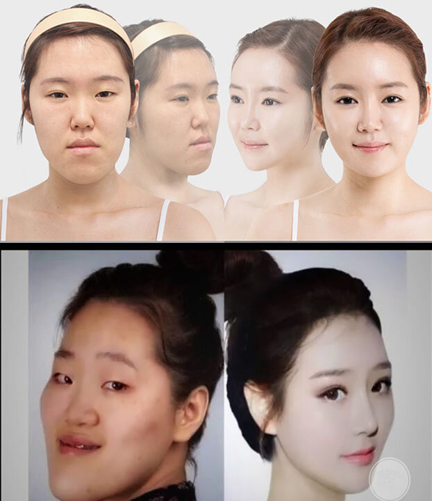 Корейцы до и после пластики фото