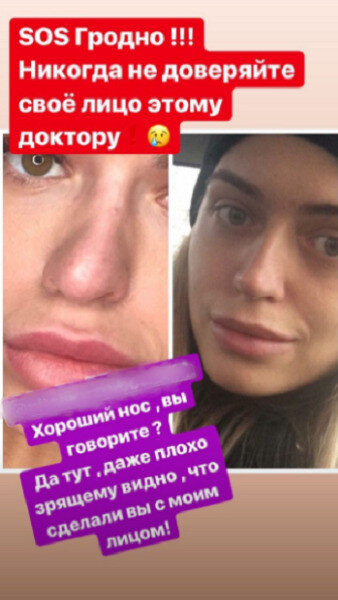Балинская до и после пластики 5 девушек из "Дома-2", которые делали пластику лица Эксперт по красоте Дзен