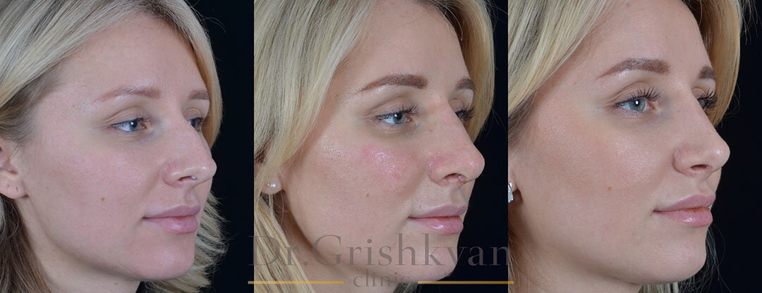 Фотографии пациентки до операции, сразу после снятия гипса и спустя 6 месяцев