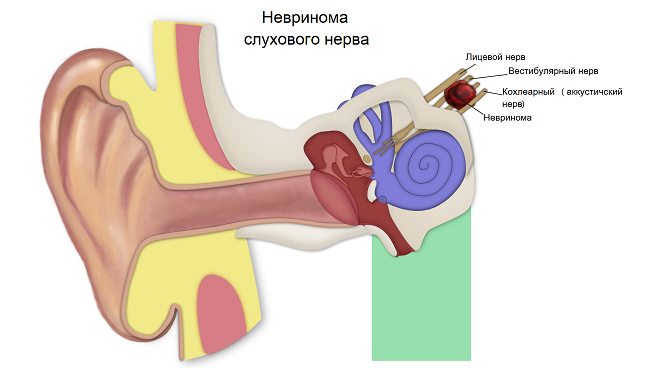 Опухоль слухового нерва, как правило, является доброкачественной, в особо сложных случаях, возможно, злокачественное ее течение.
