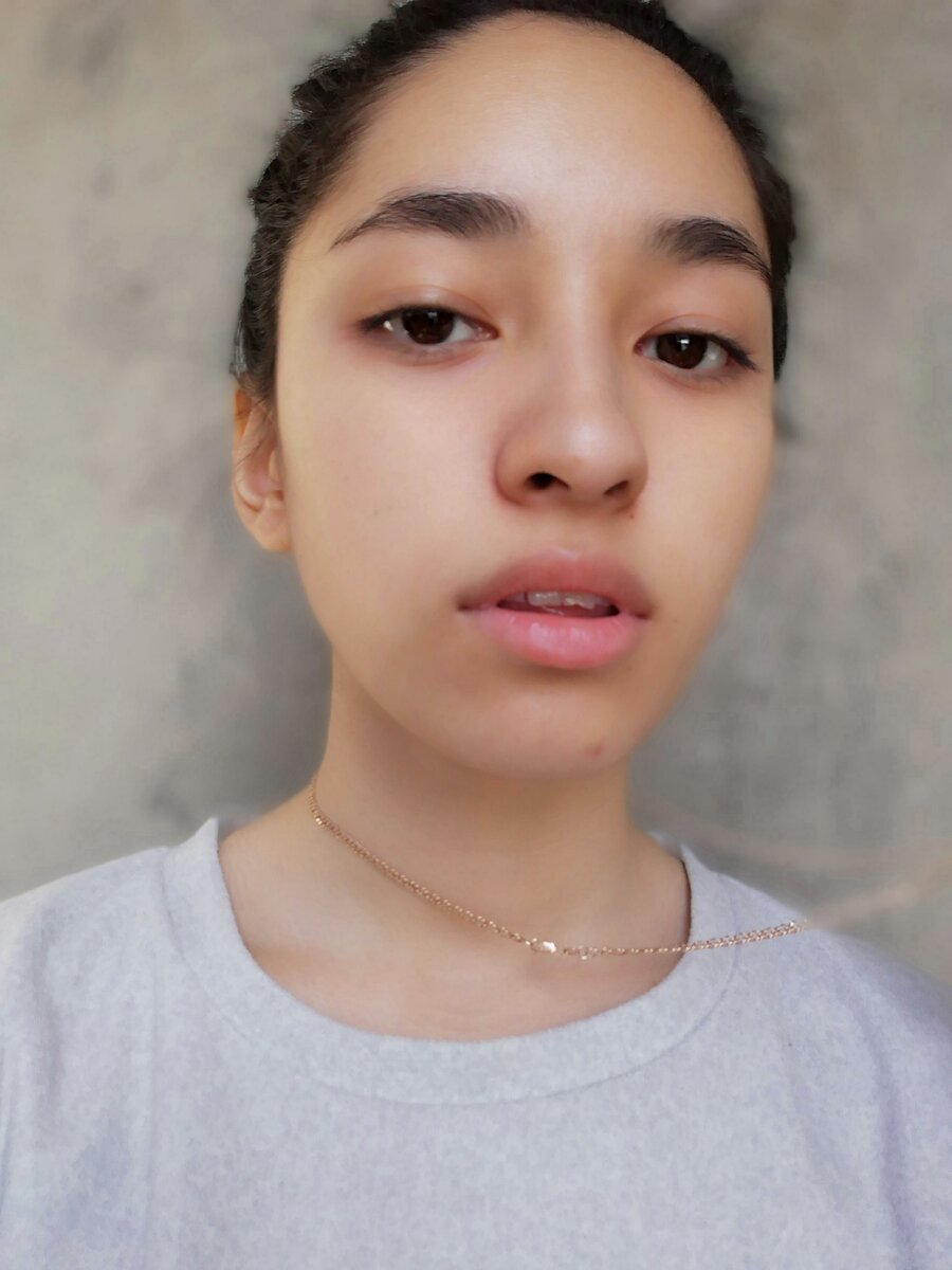 Кожа сейчас, и как видно, прыщи есть, но локально, а не все лицо. 