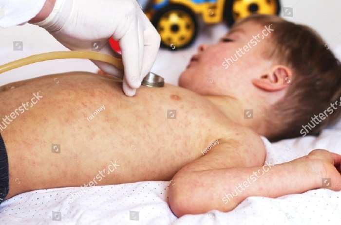 Корь. Фото с сайта shutterstock.com 