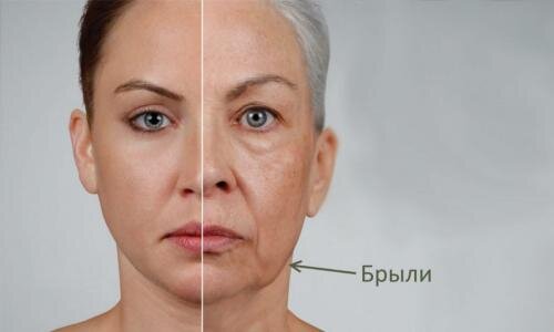 Как убрать брыли на лице