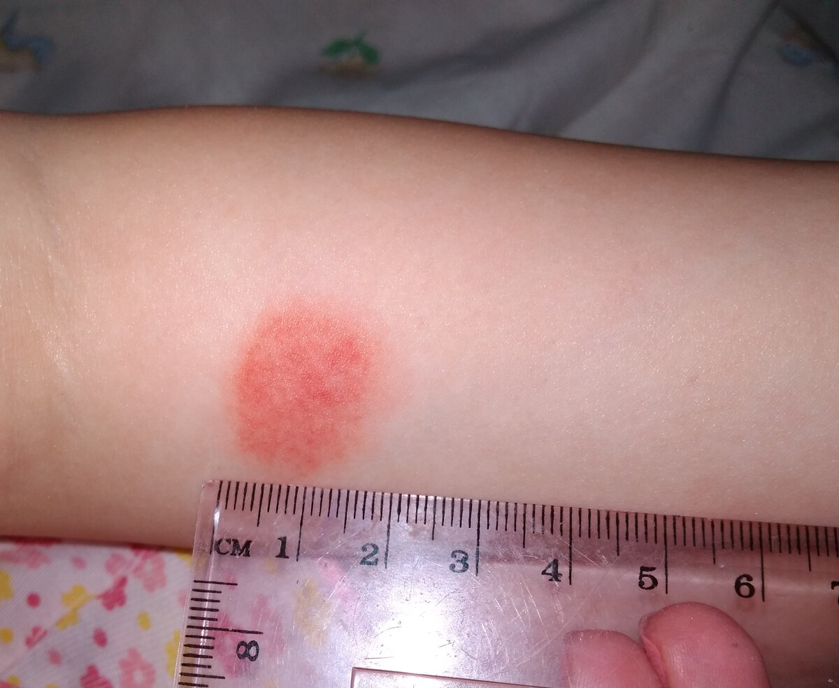 "Манту" вечером в день прививки