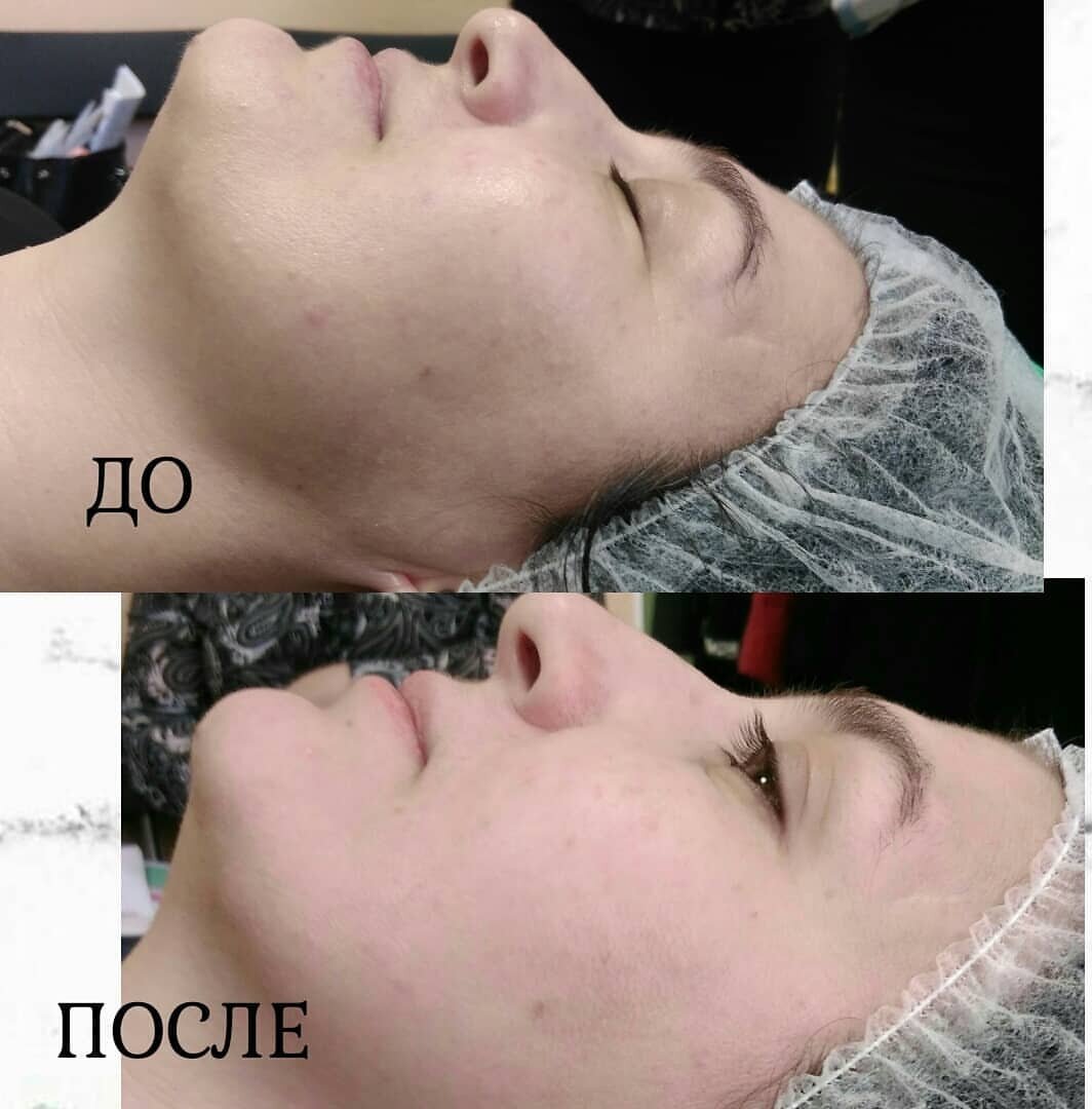 1 процедура карбокситерапии