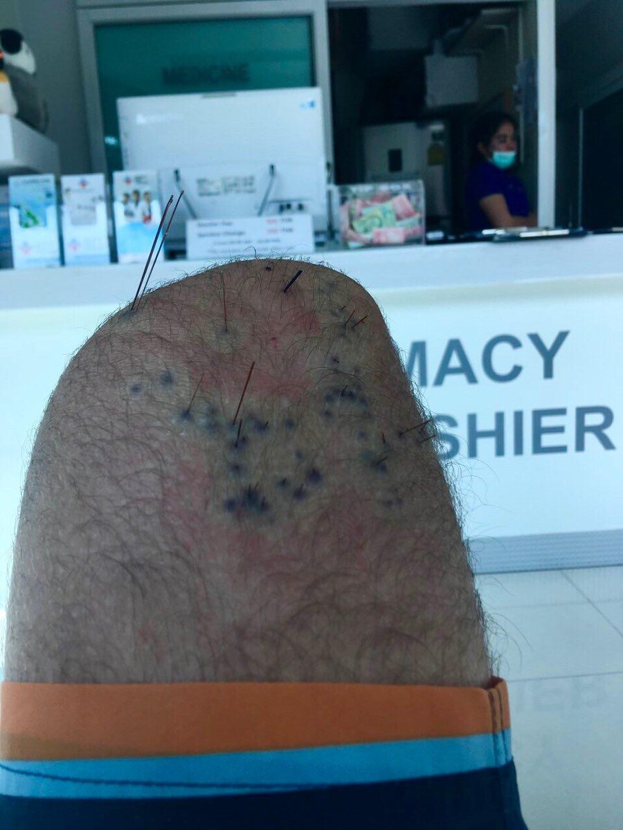 В приёмном покое. Почернения  — это реакция тела на иголки ежа