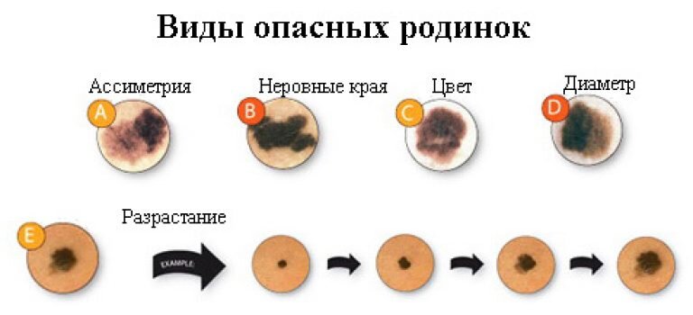 Выделения из родинок, кровотечения, боли: как распознать у себя меланому