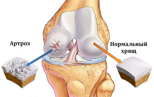 Пример хрящевой ткани, коленного сустава