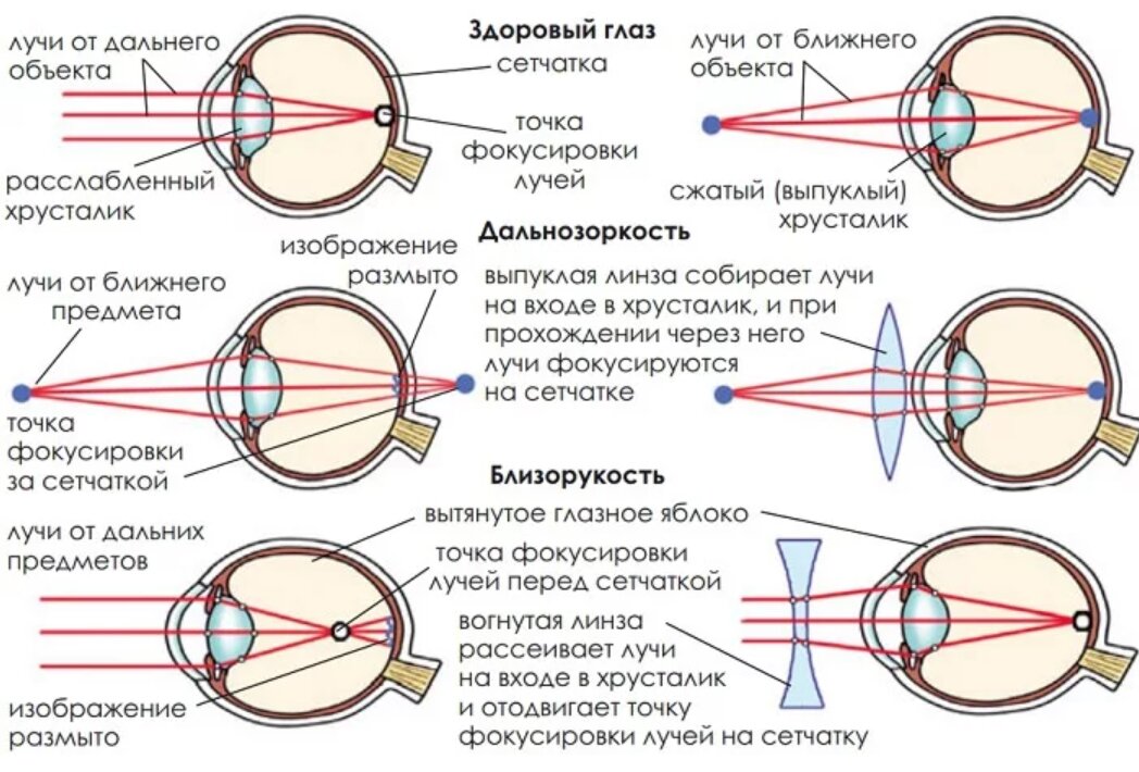 Преломляет лучи в глазу. Близорукость и дальнозоркость схема рефракции. Схема рефракции при нормальном зрении. Ход лучей близорукость и дальнозоркость. Схемы рефракции при нормальном зрении при миопии при гиперметропии.