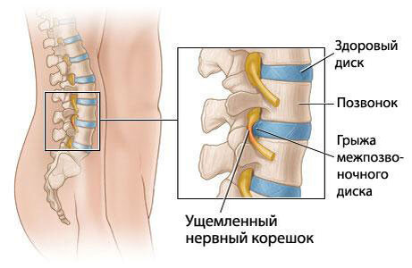 Мышечное напряжение. Мышечный спазм | Клиника Ринос