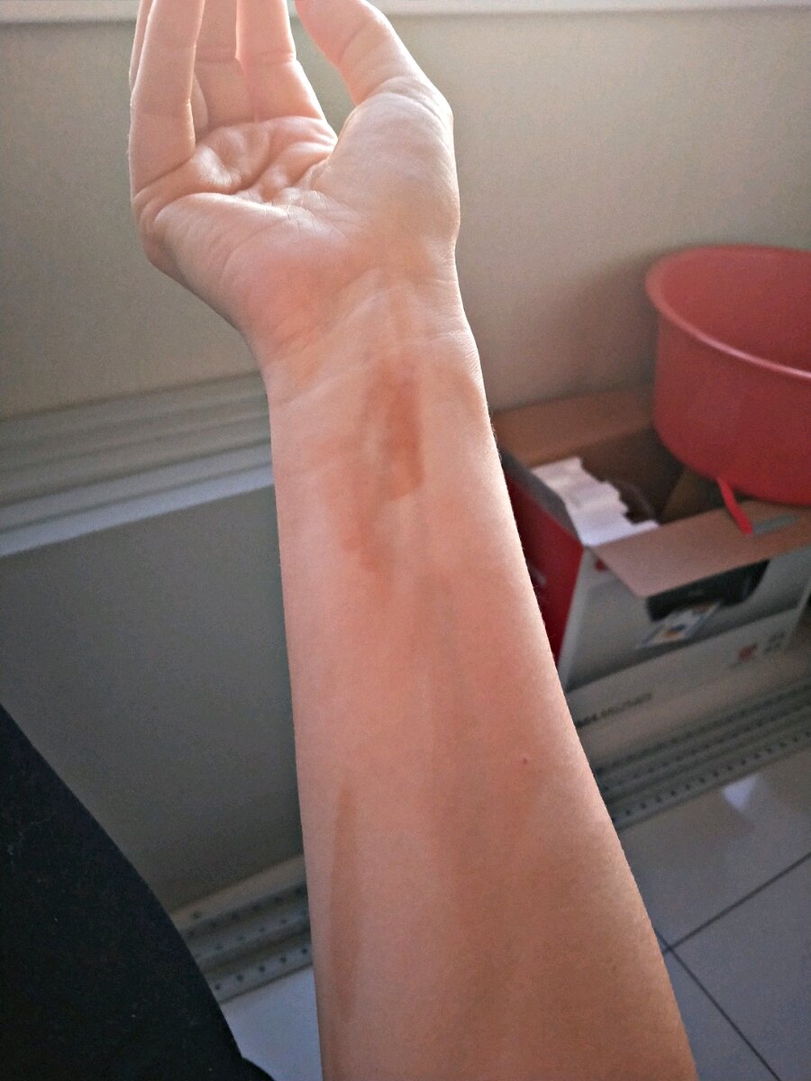 Вот такие пятна по всему телу 😆