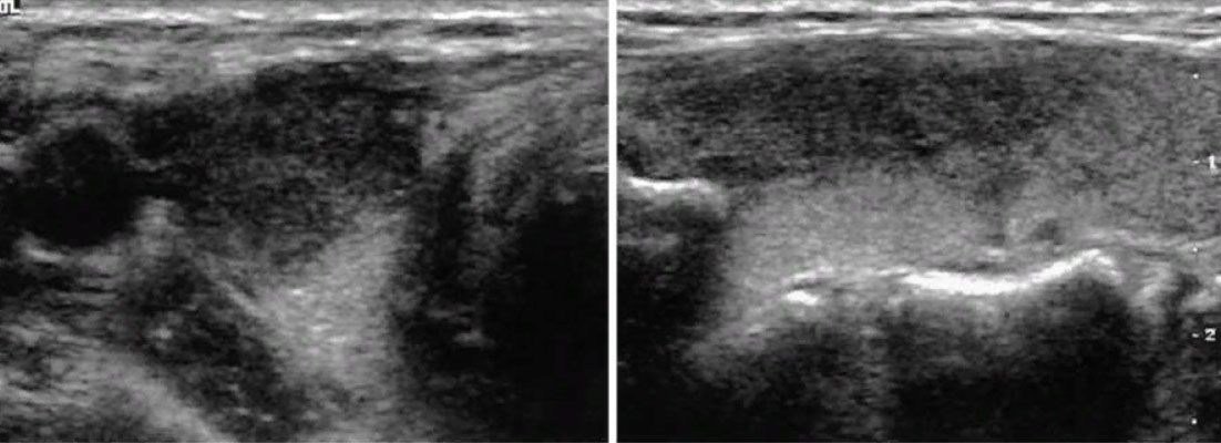 Подострый тиреоидит на УЗИ. Острый тиреоидит УЗИ картина. Подострый тиреоидит на УЗИ признаки. Подострый тиреоидит де Кервена.