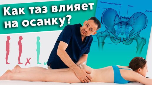 Как исправить осанку? Перекос таза, как причина нарушения осанки!