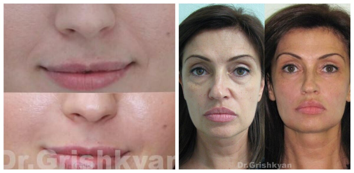 Коррекция носогубных складок. Фото до и поле. Фото с сайта Д.Р. Гришкяна. Имеются противопоказания, требуется консультация