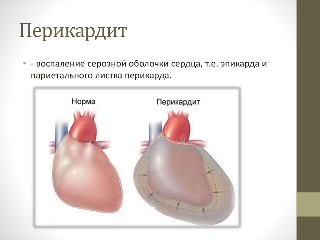 Полость перикарда сердца. Травматический перикардит Ветеринария. Оболочки сердца перикард. Париетальный листок перикарда. Перикардит презентация.