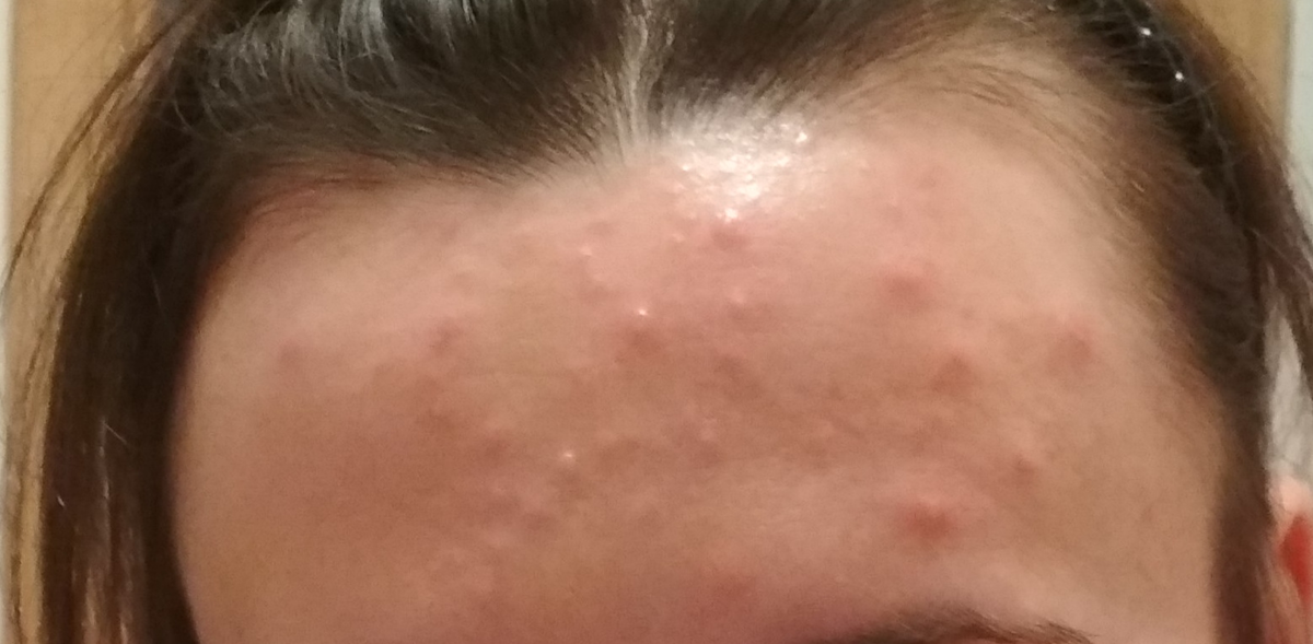         ( та ещё гадость! лоб зелёнкой мазать не стала ) 