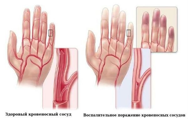 Фото с сайта https://blotos.ru/simptomy-i-lecenie-bolezni-burgera-bolezn-burgera-ili-kak-ee-nazyvaut-oficialnym-imenem-obliteriruusij-trombangiit-avlaetsa-vospalitelnym-zabolevaniem-melkih-i-srednih-krovosnabzausih-sosudov