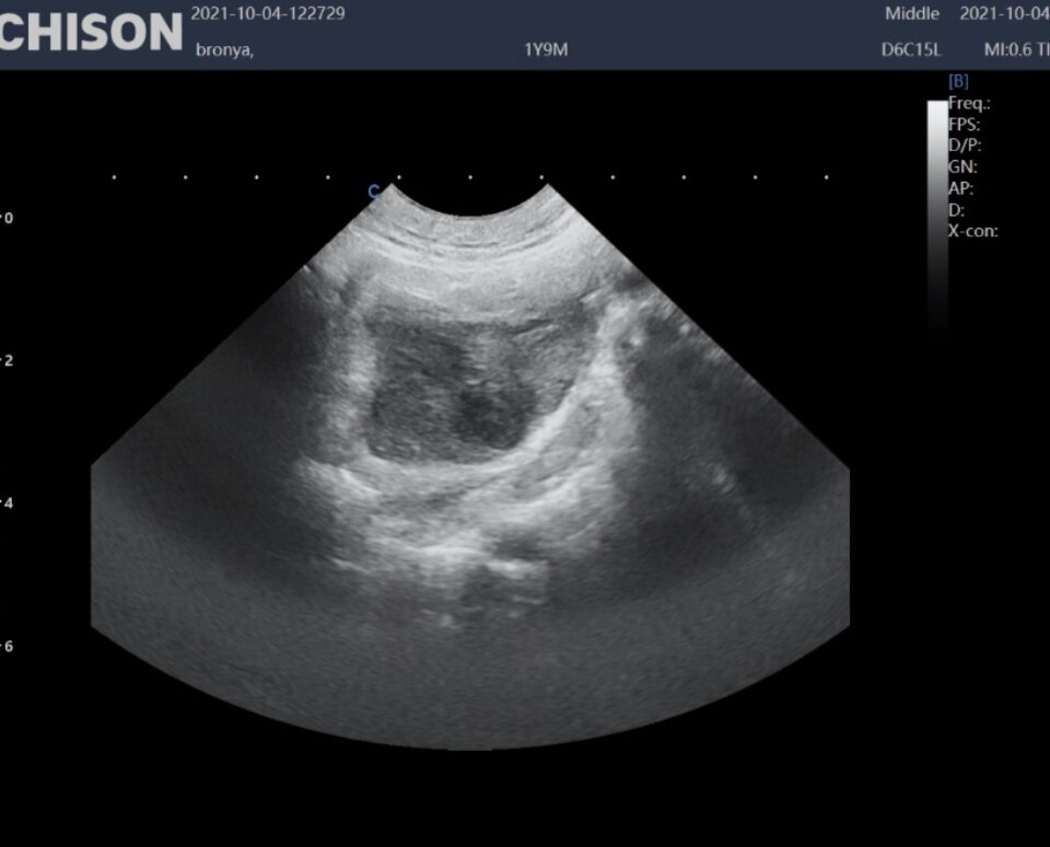 Структура в области правого яичника