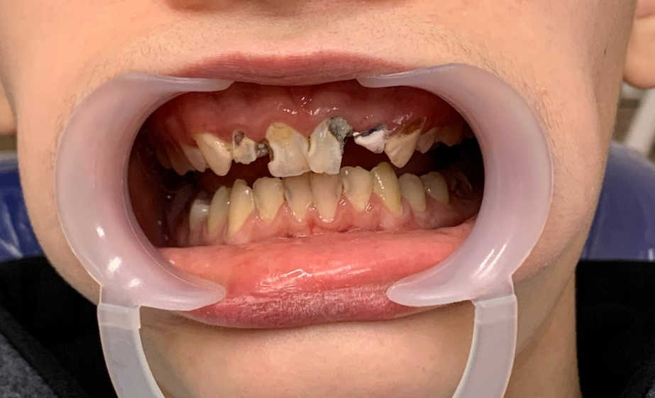 Фото разрушенных зубов.