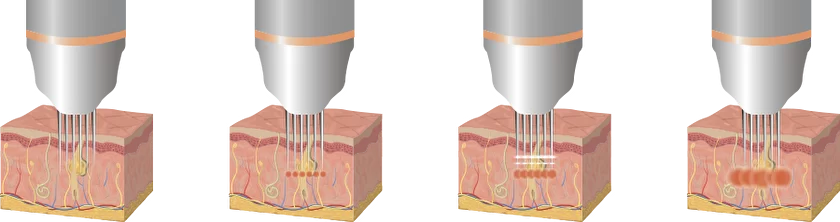 принцип действия игольчатого rf лифтинга