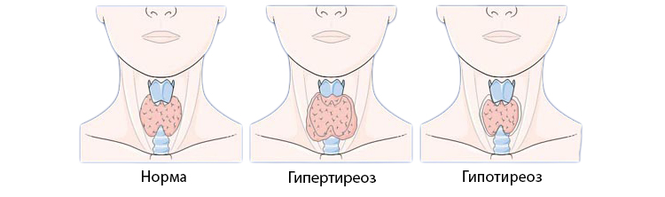 Аплазия щитовидной железы. Гипоплазия перешейка щитовидной железы. Гипоплазия щитовидной железы железы. Гипотиреоз УЗИ щитовидной железы. Аплазия и гипоплазия щитовидной железы.