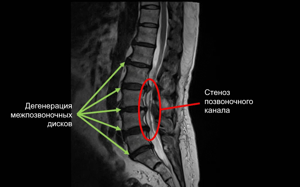 С согласия пациентов публикуем их истории. Пациент – женщина, 60 лет История болезни Несколько лет назад появились боли в пояснице. Боль возникает, когда стою.