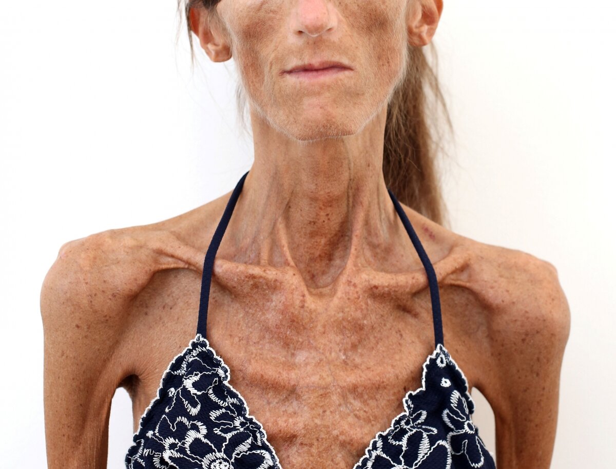    Анорексия Wp.libertatea.ro