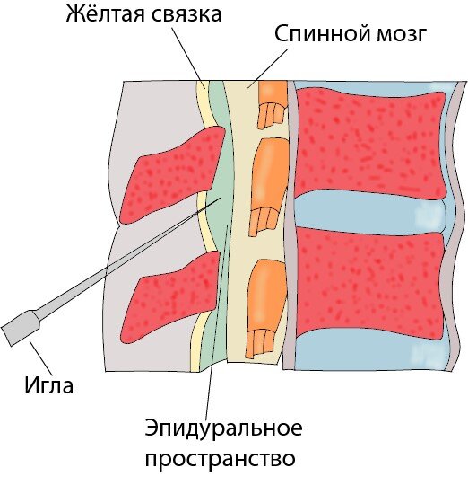При эпидуральной блокаде достигается максимальная концентрация лекарства в очаге