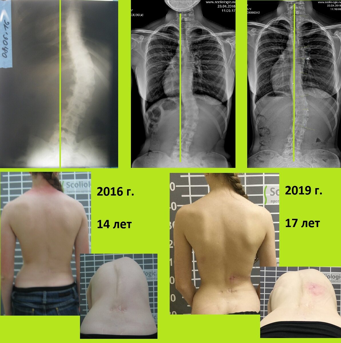 Степени сколиоза картинки