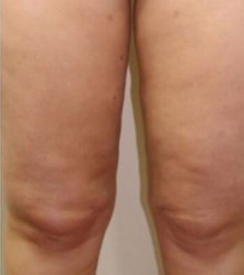 После курса процедур