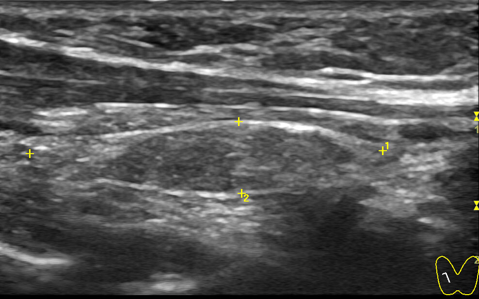 Канадское УЗИ щитовидной железы или 