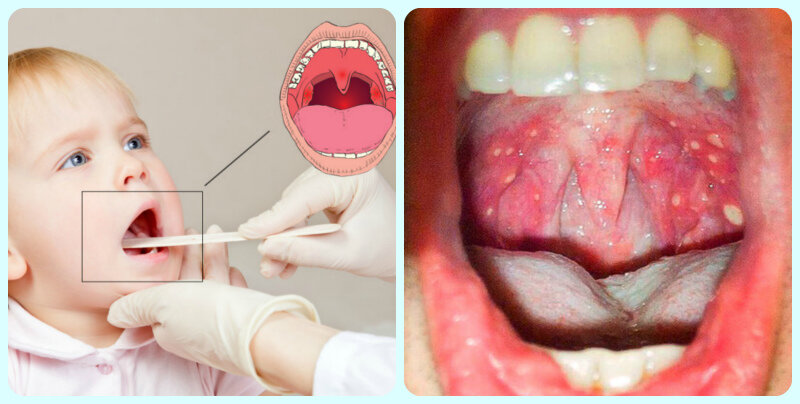 Частые ангины у ребенка - что делать? - ЛОР клиника №1