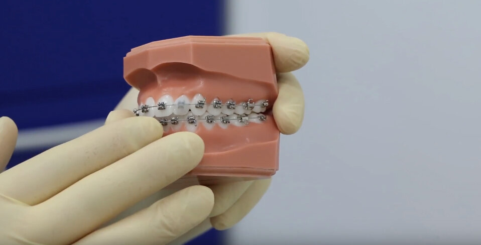 Когда Вам поставили брекет-систему, Ваш организм должен адаптироваться к этому. Обычно это происходит в течение первой недели ношения. Ваши внутренняя сторона щеки привыкла что на зубах ничего нет, и поэтому к ней плотно прилегает. Когда появляются брекеты, то слизистая почти всегда будет где-то натираться. Соответственно Вам будет выдан ортодонтический воск, или силикон. Мы отрываем небольшой кусочек воска, разминаем его в руках и делаем шарик. Дальше в идеале нужно высушить брекет который вас натирает с помощью ватной палочки. После этого берем воск и залепляем поверхность брекета. Так делаете со всеми брекетами которые Вас натирают. Соответственно поверхность брекета стала более гладкая, и перестанет натирать.
