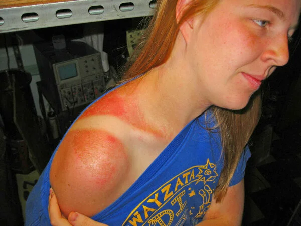 Возможный вид ожогов на теле. А также не забывайте оставлять комментарии и лайки) Всё это поможет качественному росту канала)