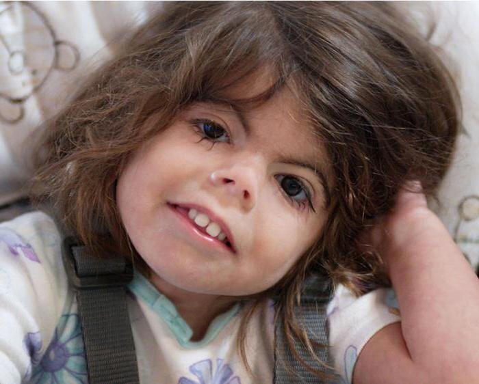 Ребенок с синдром Корнелии де Ланге