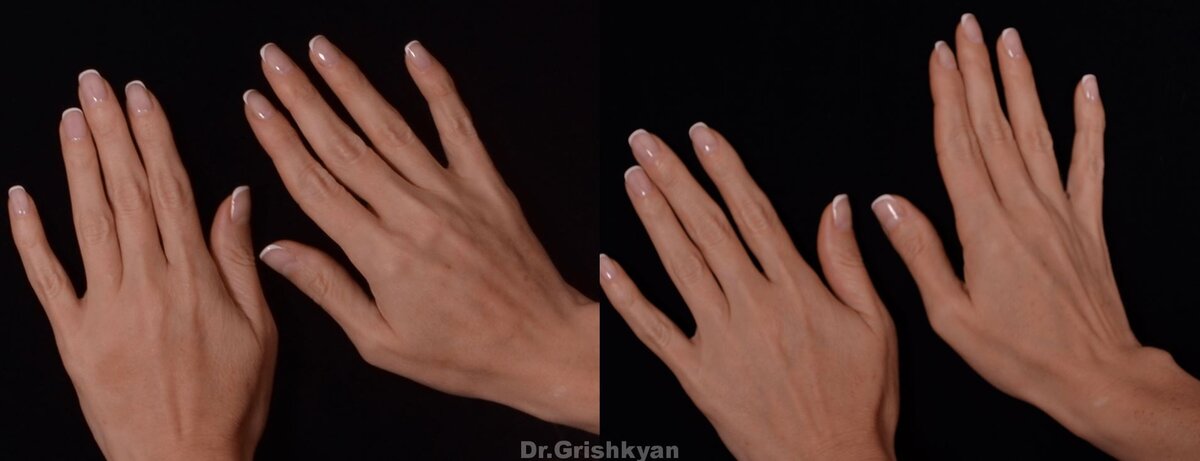 Липофилинг рук фото до и после. Фото с сайта Д.Р. Гришкяна. Имеются противопоказания, требуется консультация специалиста