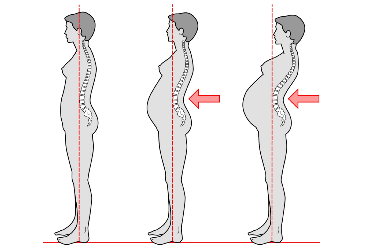 Рост после беременности. Лордоз позвоночника при беременности. Лордоз поясничного отдела позвоночника после беременности. Осанка. Позвоночник беременной женщины.