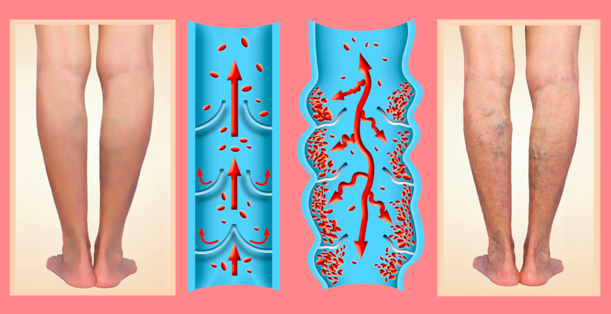 Нормальные вены и тромбоз