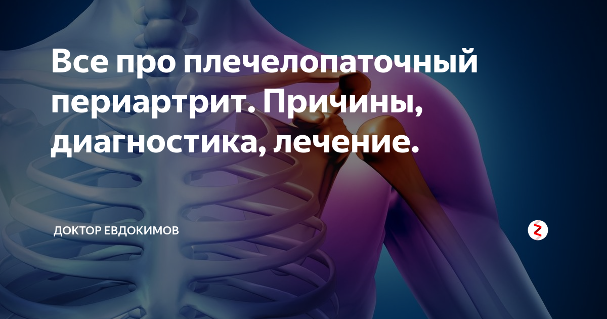 Евдокименко периартрит. Плечелопаточный периартрит диагноз. Левосторонний плечелопаточный периартрит. Лопаточный периартрит симптомы. Плечелопаточный периартрит лечебная гимнастика.