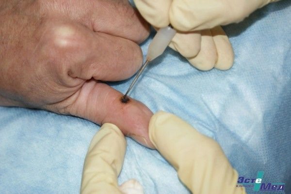  Электрокоагуляция