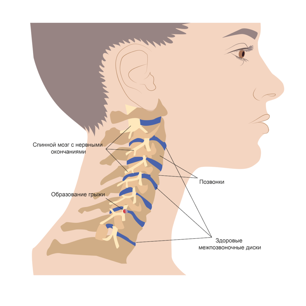 Схема лечения грыжи шейного отдела позвоночника препараты