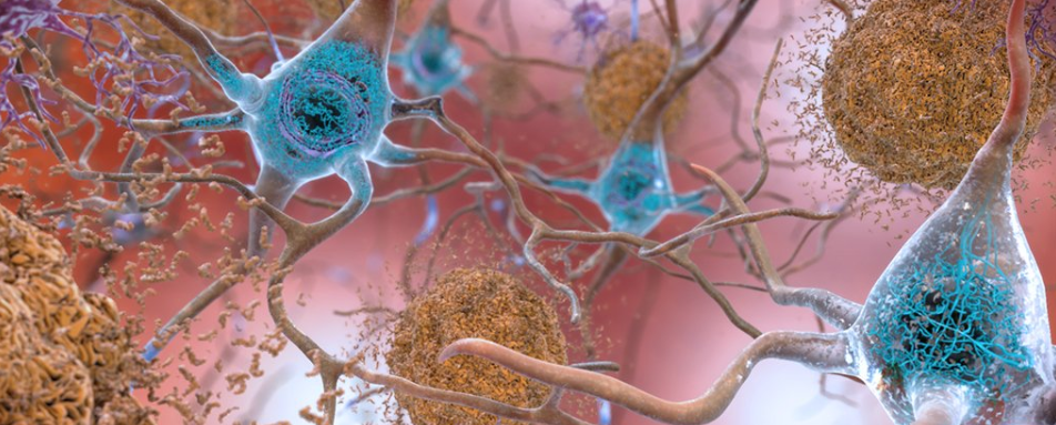 Бета-амилоидные образования при болезни Альцгеймера