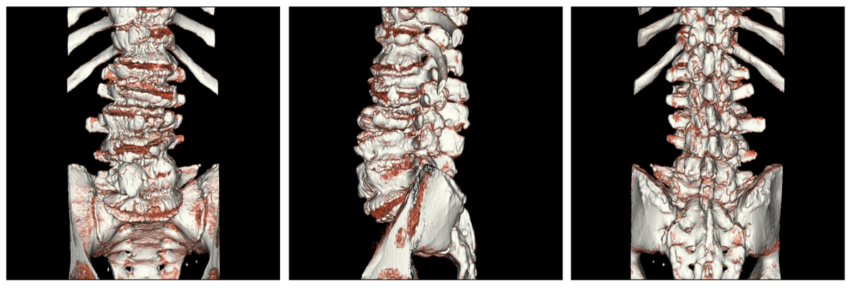 И если должная подвижность грудного отдела позвоночника утеряна из-за травмы или образа жизни, все компенсации лягут на поясничный отдел, не приспособленный для таких движений природой, что и приведет к травме. Примерно так же обстоит ситуация с разгибанием позвоночника. Если ваши плечи не достаточно подвижны для плавания, ситуация будет компенсироваться переразгибанием поясничного отдела. Итак, резюмируя все сказанное выше, перед тем, как начинать плавать, я очень советую Вам пообщаться с хорошим физиотерапевтом или специалистом по движению, который поможет протестировать все необходимые качества. Или, хотя бы, протестируйте их самостоятельно. Во второй части своей статьи я расскажу о том, как сделать это наиболее эффективно, а так же, расскажу об упражнениях, которые помогут Вам быстрее освоить качественный навык плавания!