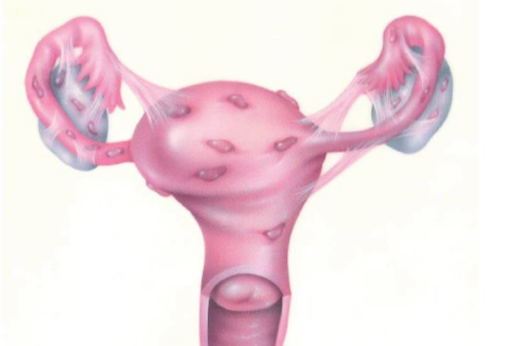 Очаги эндометриоза