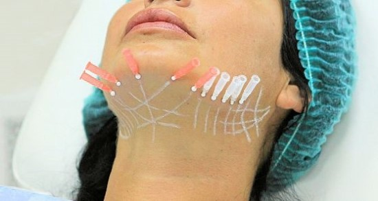 Часто в тренд вводится наиболее выгодное, но не самое эффективное. Мне больше интересен вопрос выработки коллагена с помощью нитей и некоего эффекта пред-лифтинга, то есть сохранения овала лица как можно дольше. В любом случае игнорировать нитевой метод уже нельзя, это именно та процедура, которая будет широко развиваться и, соответственно, активно предлагаться до тех пор, пока на смену не придет новый косметологический тренд.