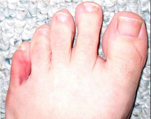  Фото: повреждение фаланг пальцев нижней конечности