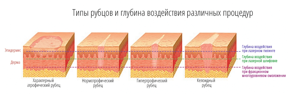 От застарелых шрамов. Лазерная шлифовка рубца этапы заживления. Лазерная шлифовка Рубцовой ткани. Лазерная шлифовка послеоперационного шрама.