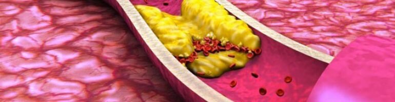 Кровоток в разрушенных артериях слабый, холестериновые бляшки создают условия для образования тромбов.