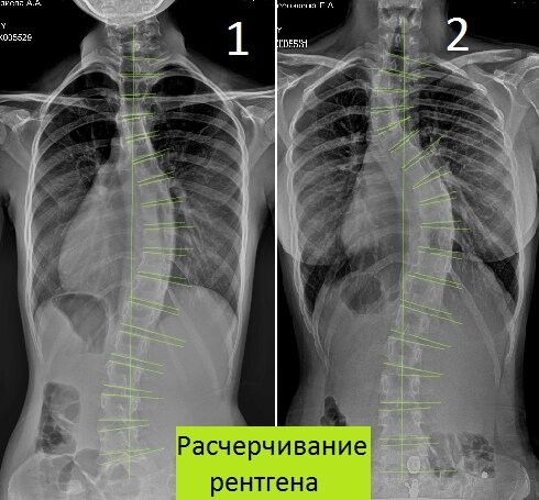 Сколиоз градусы