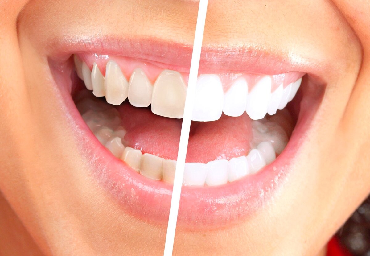 Как правильно сделать отбеливание зубов в домашних условиях
